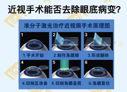 近視手術(shù)能否去除眼底病變？